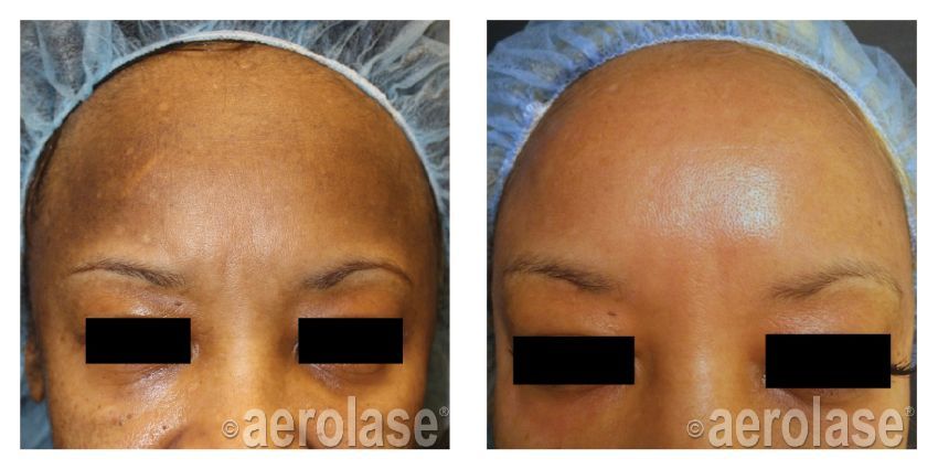 Side-by-side forehead close-ups showing skin improvement before and after treatment.