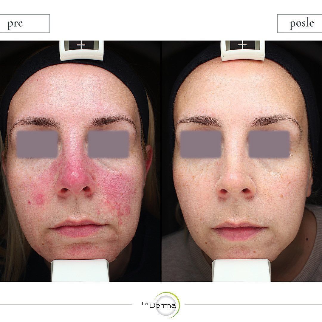 Side-by-side face photos labeled before and after, showing reduced cheek redness and a calmer complexion