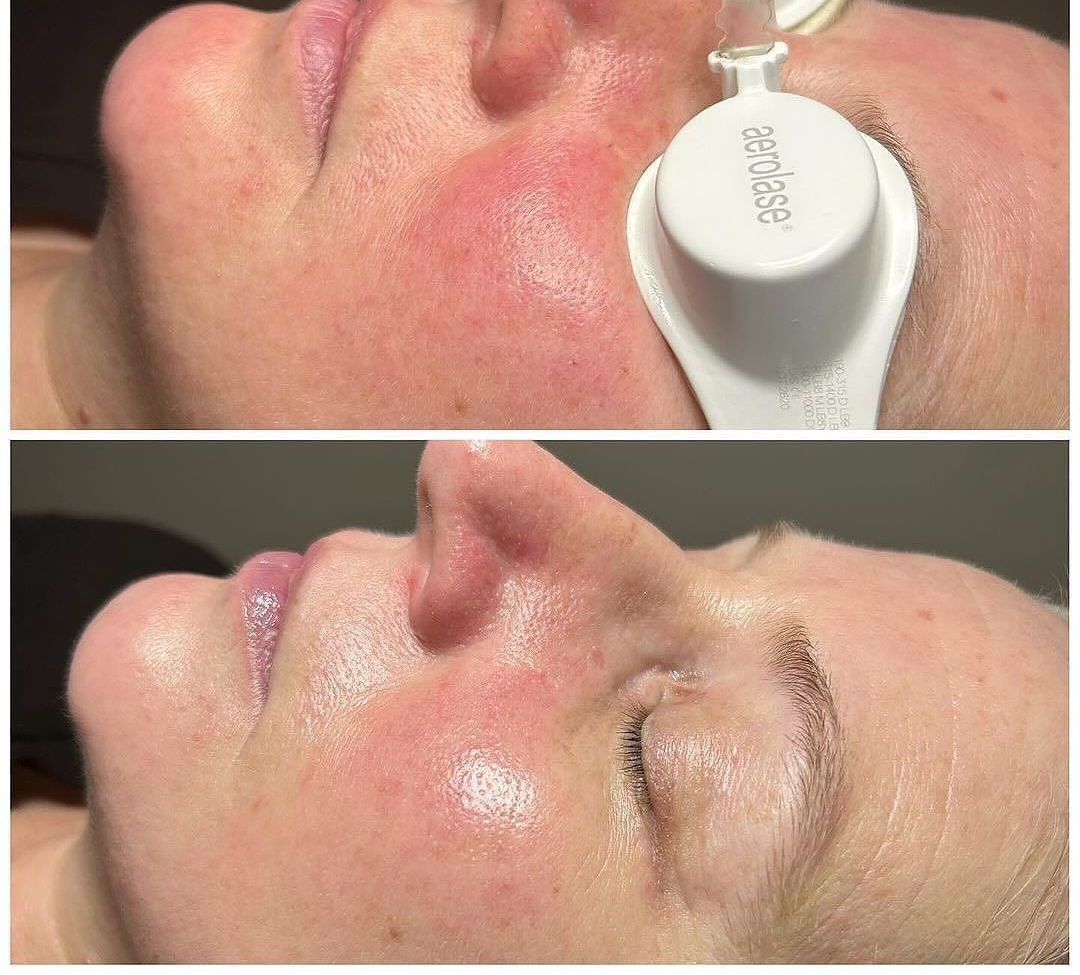 Side-by-side close-up of a face before and after a skin treatment, showing reduced redness on the cheek.