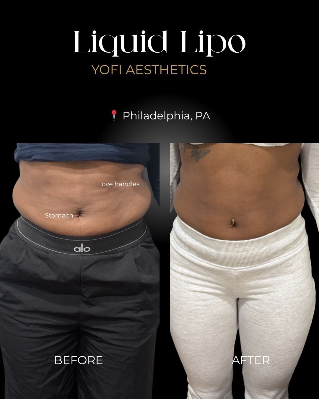Liquid Lipo procedure before and after photos. Black text on black background with Philadelphia, PA location.