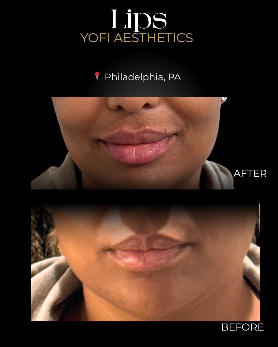 Lip filler before and after: upper lips fuller after treatment. Philadelphia, PA location.