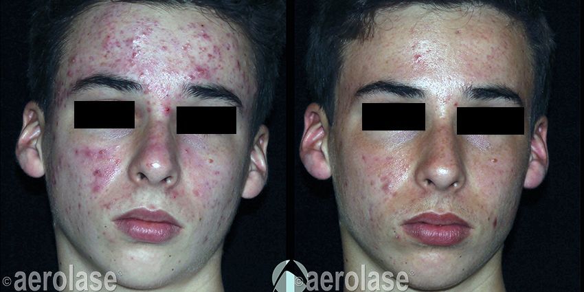 Side-by-side facial photos showing acne before and after treatment, with reduced redness on the right