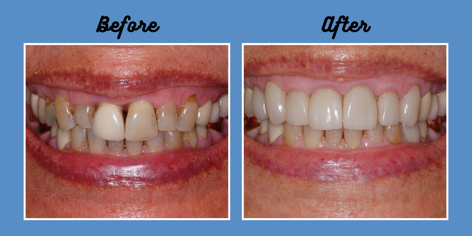Before and after of teeth whitening. The before shows discolored teeth. The after shows bright, white teeth.