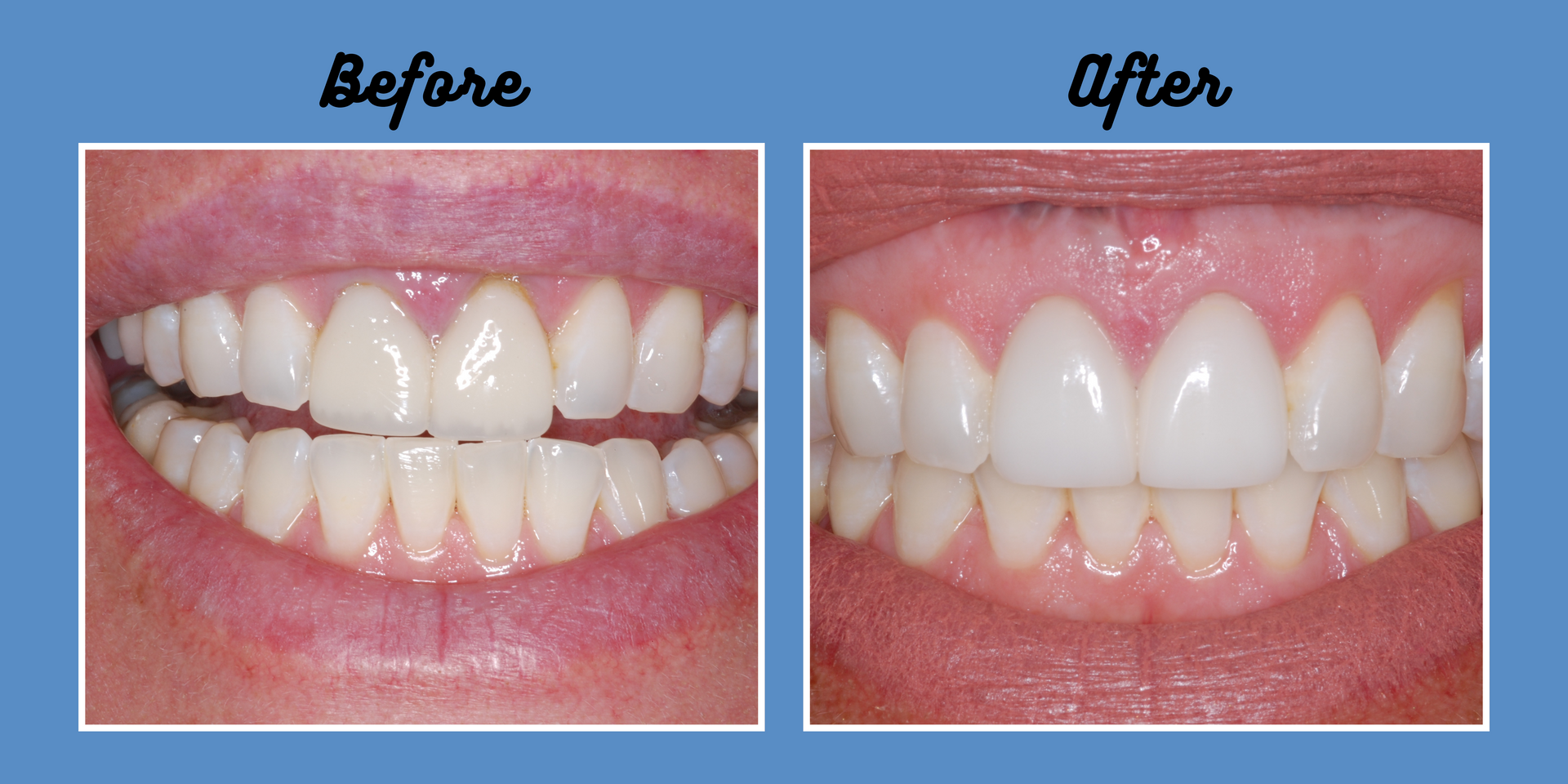 Side-by-side comparison: Before and after dental work. Teeth are whiter and gaps are closed in the 
