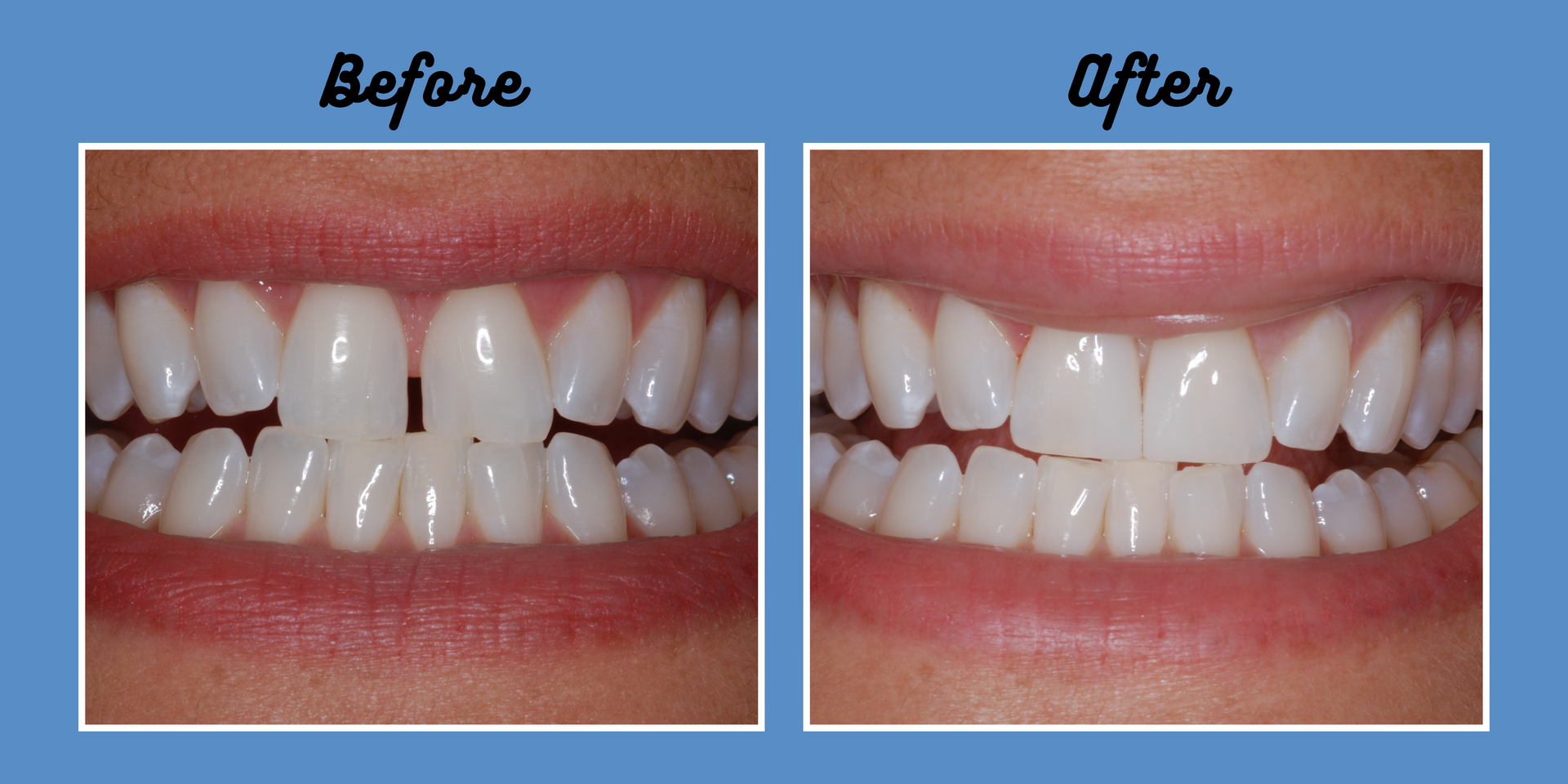 Before-and-after of teeth. Before: Gap between teeth. After: Straight, even teeth.