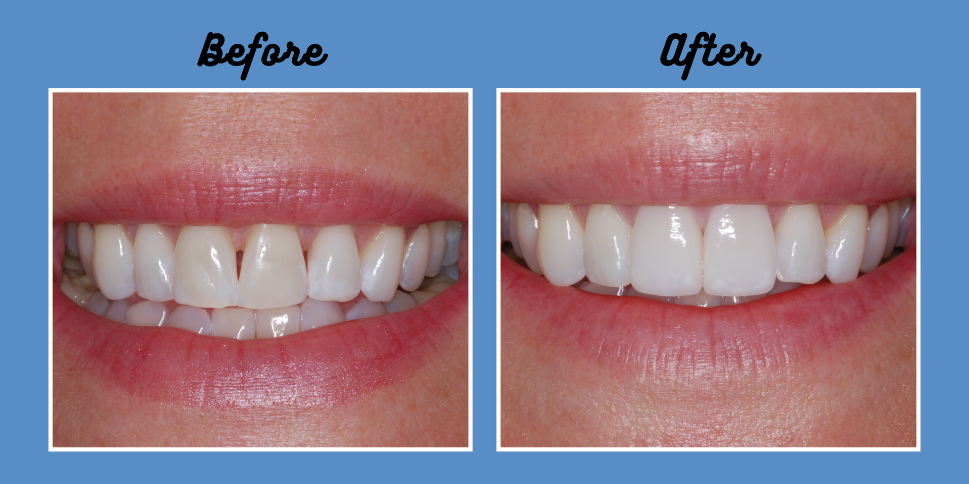 Side-by-side comparison of teeth; before shows a gap, after shows a perfected smile.