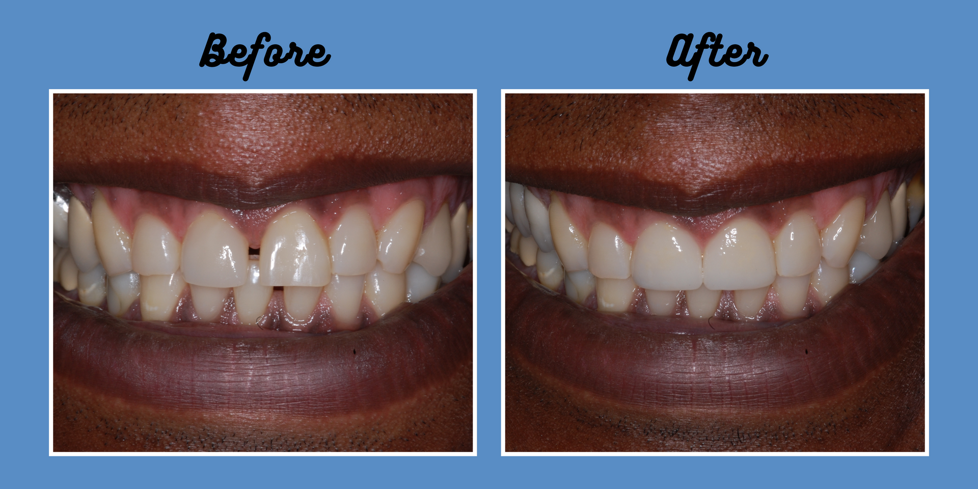 Dental teeth before and after treatment, teeth are whiter and gap is closed.