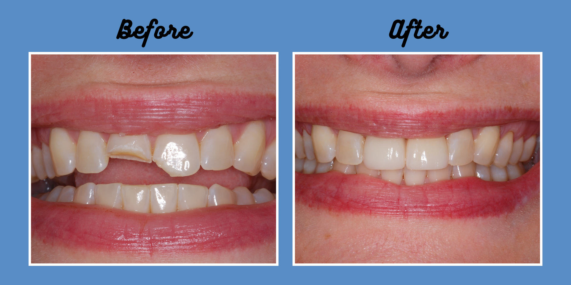 Side-by-side comparison of teeth. The left side shows a chipped tooth before repair, while the right side displays the repaired teeth.