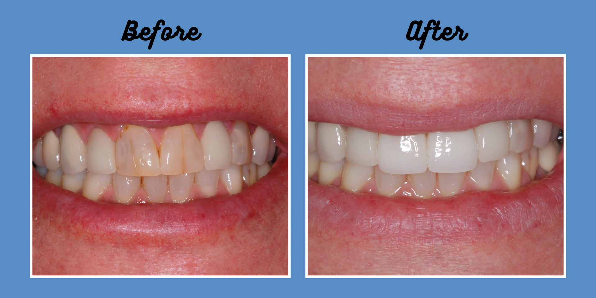 Side-by-side teeth comparison: 
