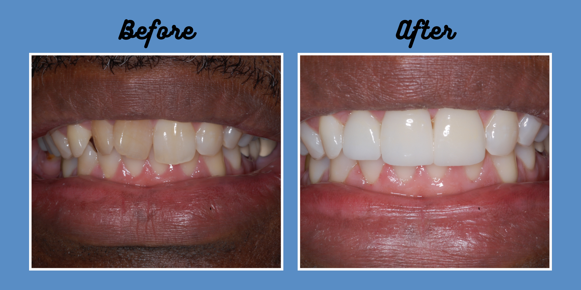 Comparison of a person's teeth before and after a dental procedure; teeth are whiter and straighter after.