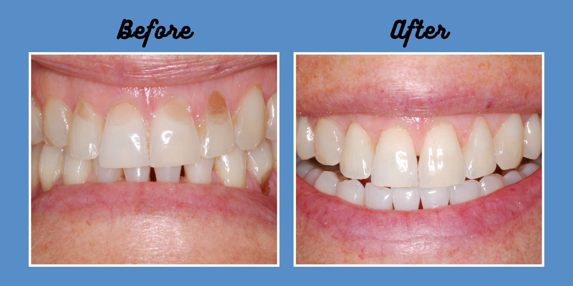 Before and after images of a person's teeth. The 