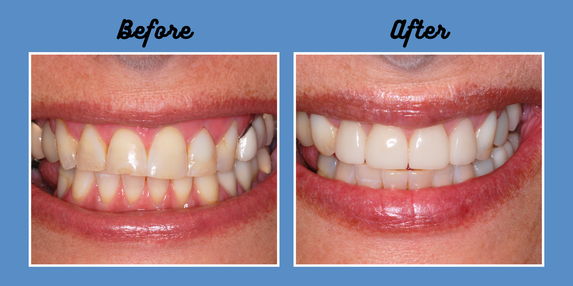 Comparison of a smile before and after dental work, showing teeth whitening.