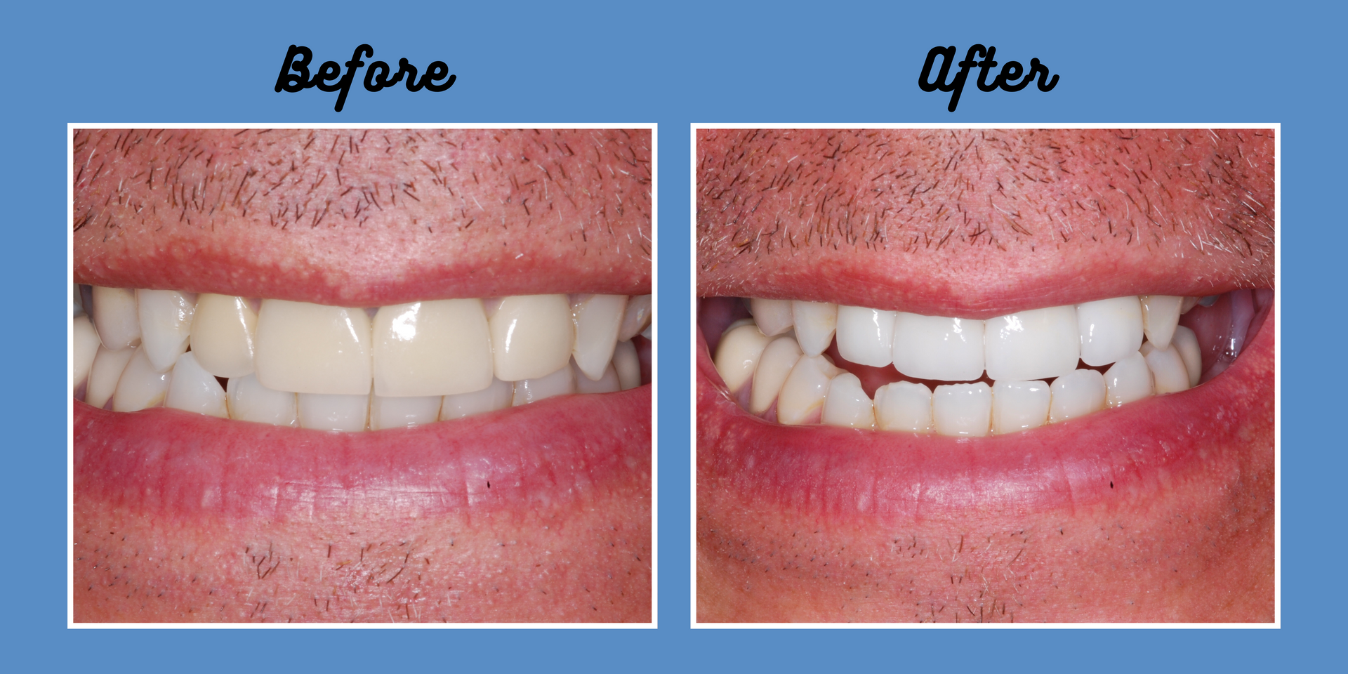 Teeth before and after cosmetic dentistry. Lighter, straighter teeth in after photo.