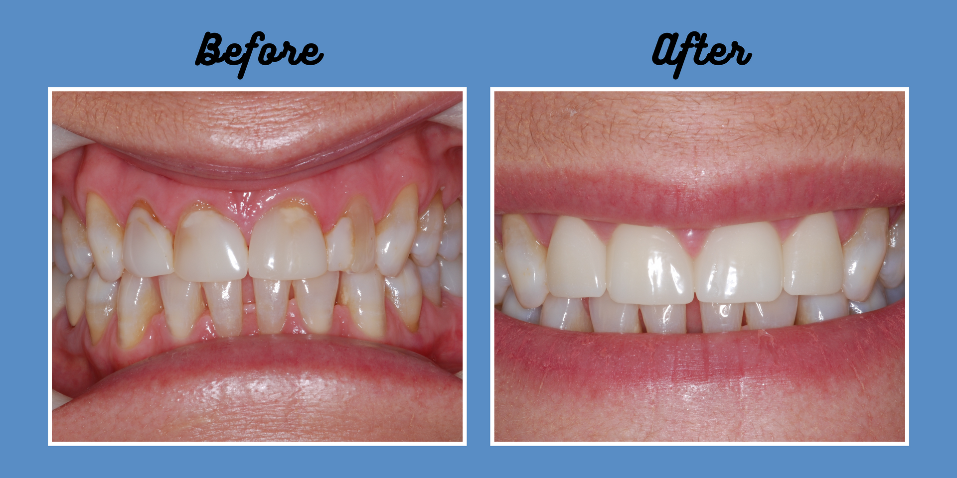 Before and after dental photo: stained, misaligned teeth become bright, straight teeth.