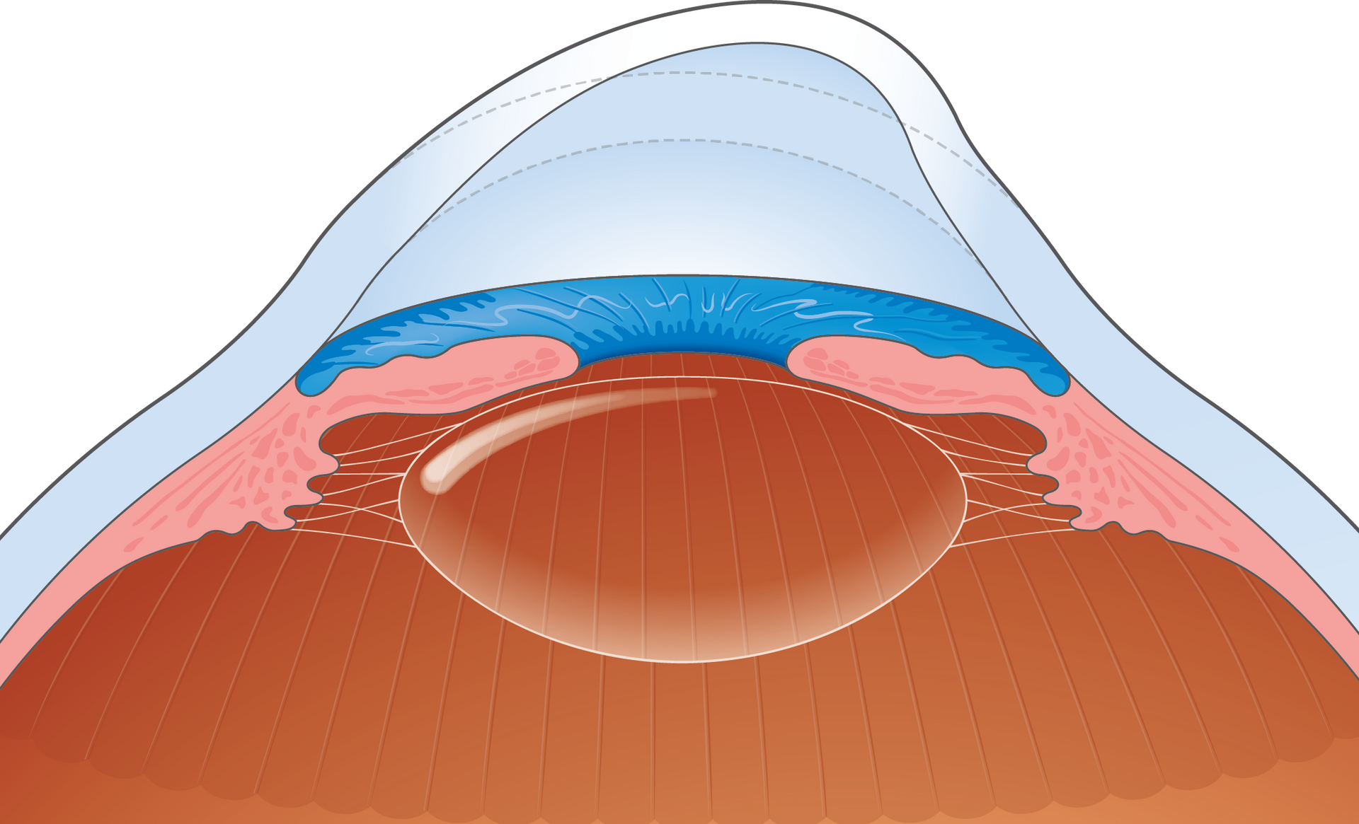 Keratokonus Spezialisierte Behandlung nordBLICK
