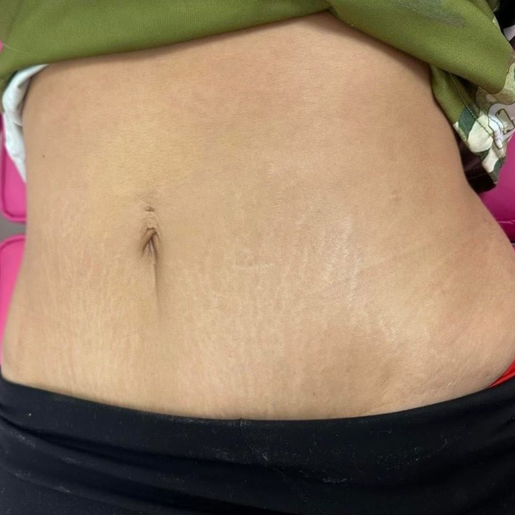 Close-up of a person's stomach showing reduced stretch marks around the navel