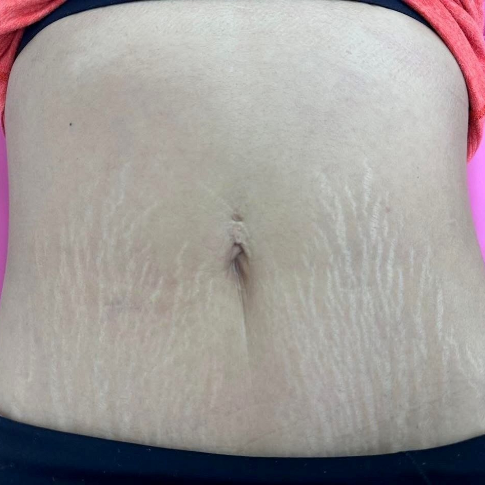 Pale skin with multiple stretch marks on abdomen.