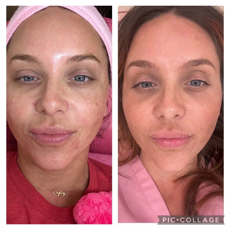 Before-and-after face comparison. Woman with visible skin improvements: reduced blemishes, brighter tone, and more even complexion.