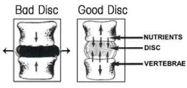 Bad Disc Versus Good Disc — Cincinnati, OH — Fick Chiropractic Centers Bad Disc Versus Good Disc — Cincinnati, OH — Fick Chiropractic Centers