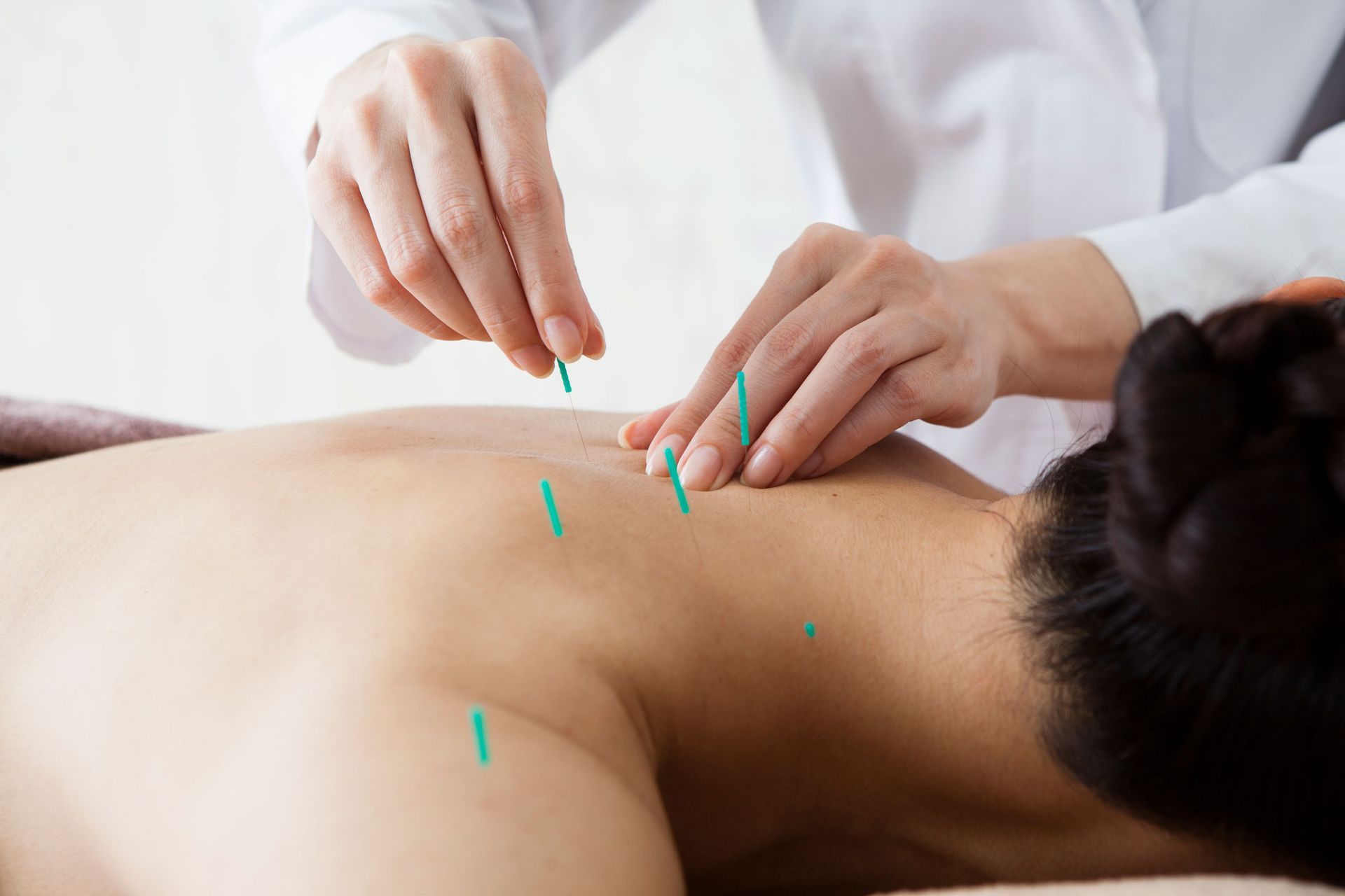 Acupuncture — Cincinnati, OH — Fick Chiropractic Centers