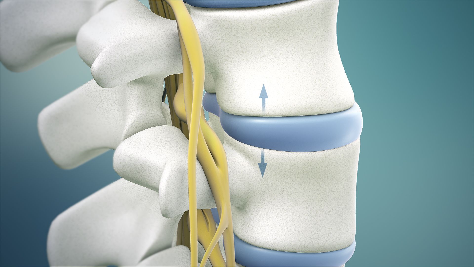 3D medical illustration of a spinal column with a blue intervertebral disc and arrows indicating vertical expansion.