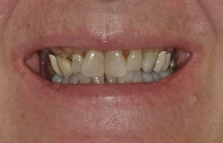 A close-up of a person's mouth showing stained, uneven teeth and receding gums.
