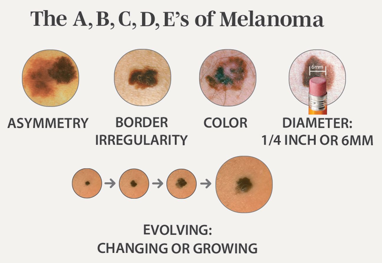 An infographic showing the ABCDE signs of melanoma: asymmetry, border irregularity, color, diameter, and evolving changes.