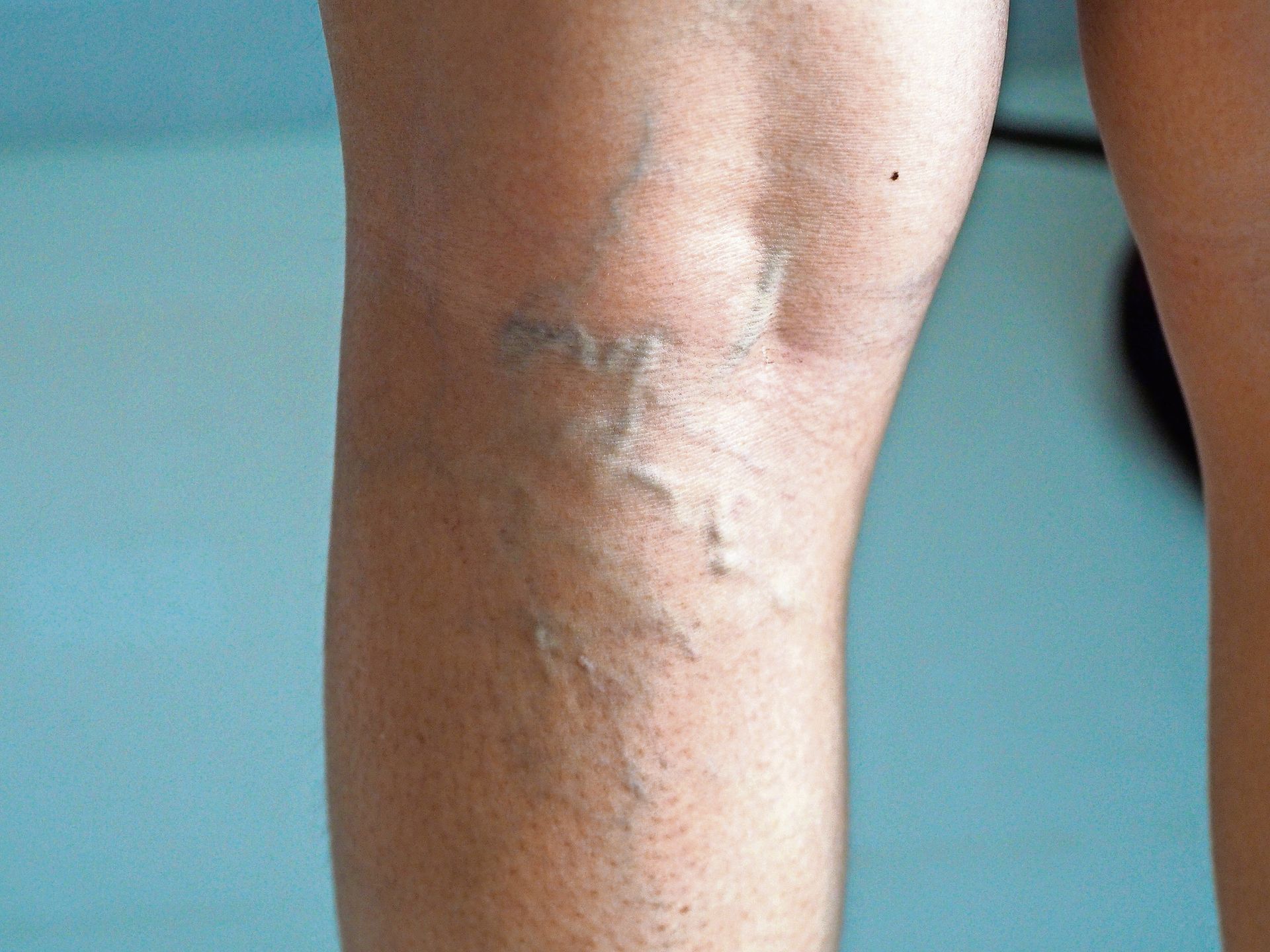 Visible, twisted, bluish-purple varicose veins appearing on the skin of a lower leg.