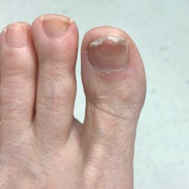Close-up of a human foot showing a discolored, thickened toenail with a jagged edge on the big toe.