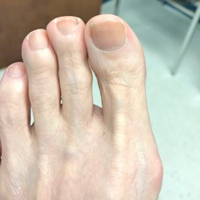 A close-up, top-down view of a human foot, focusing on the toes and the upper portion of the midfoot.