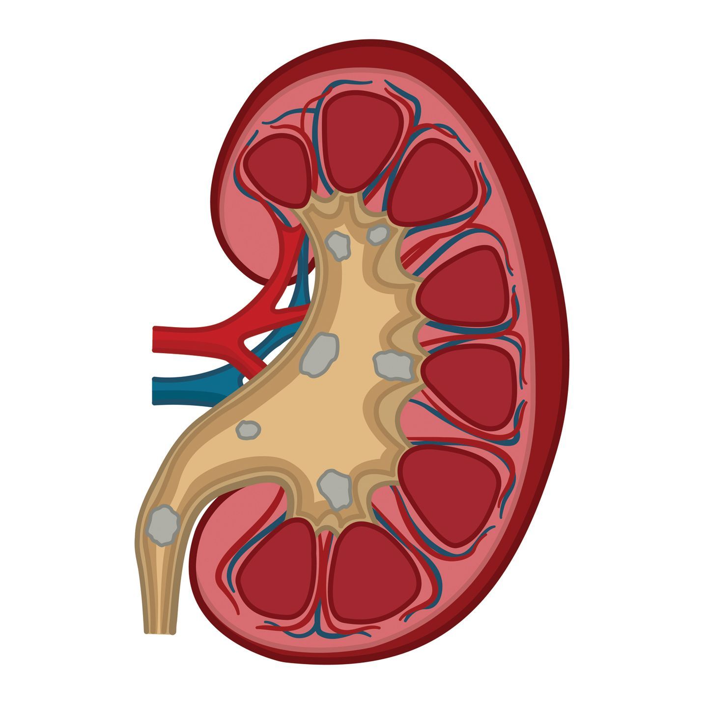 Cross-section diagram of a human kidney showing multiple grey stones located within the renal pelvis and calyces.