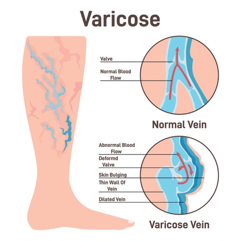 An illustration comparing a normal vein with proper blood flow to a deformed, dilated varicose vein causing skin bulging.