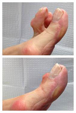 Two photos of a foot showing a severe hallux valgus deformity with the big toe overlapping the second toe.