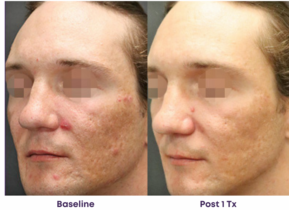 Before and after comparison showing reduced facial acne and improved skin texture following one treatment.