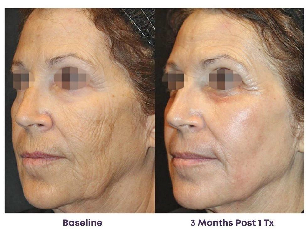 Before and after comparison showing skin texture improvement and reduced fine lines after one cosmetic treatment.