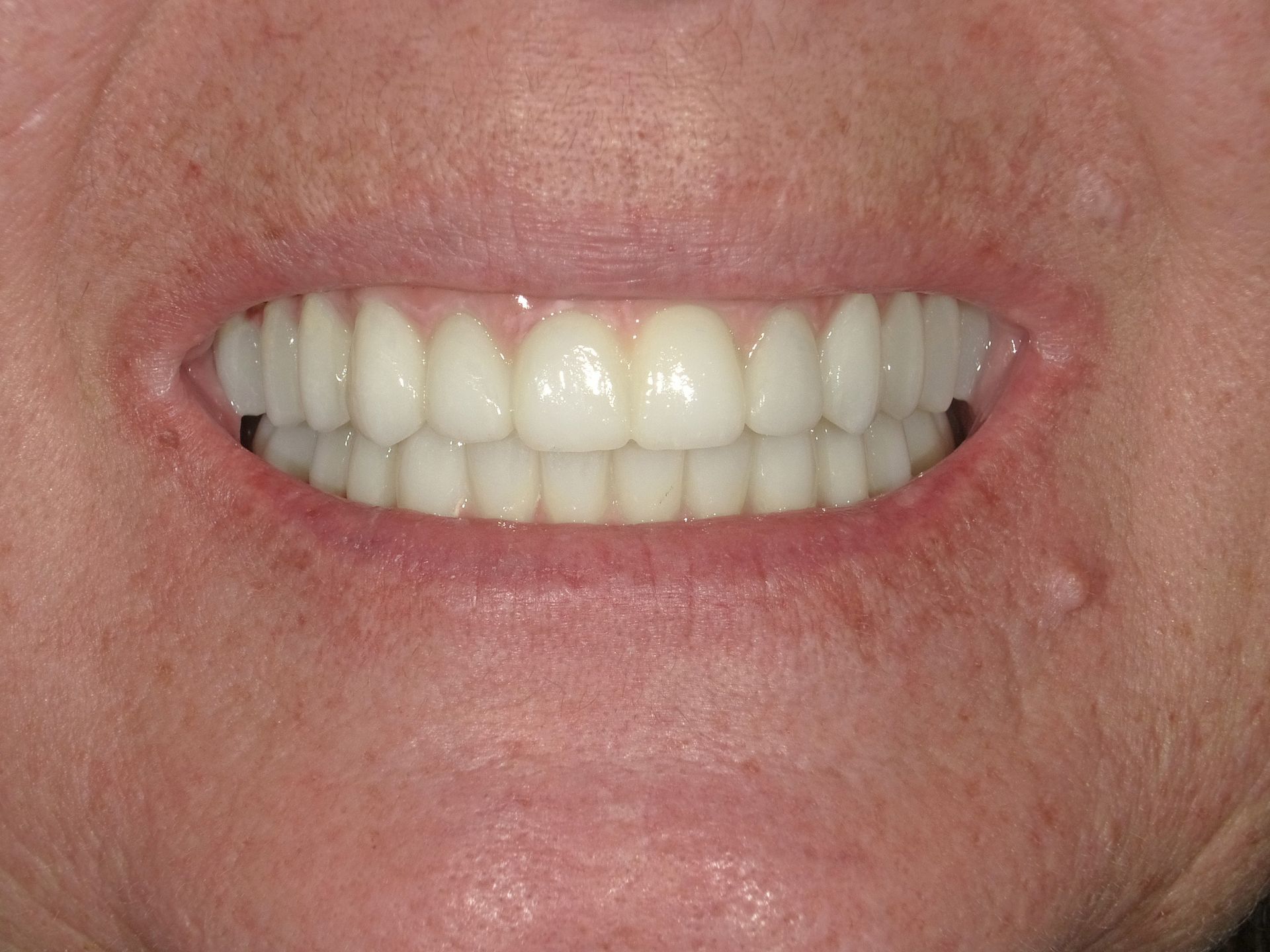 Close-up of a person's mouth showing a full set of white, even dental restorations.