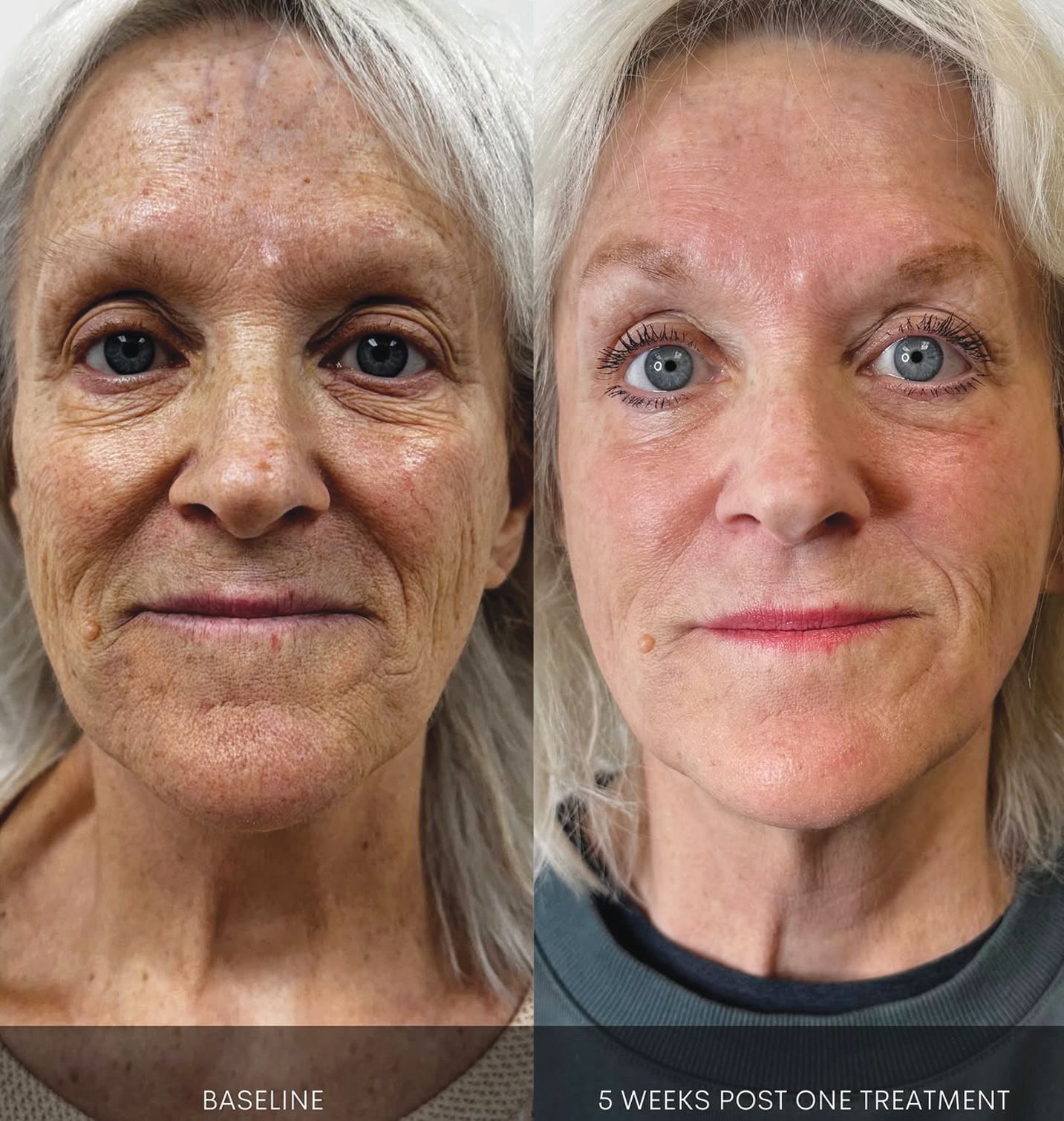 Before and after comparison of facial skin showing reduced fine lines and improved tone after a single treatment.