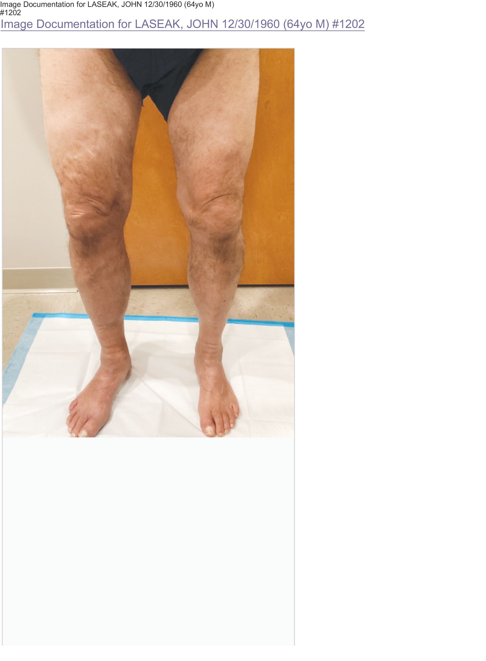 A person's lower body, focusing on the legs and knees, standing on a white paper-covered examination table.