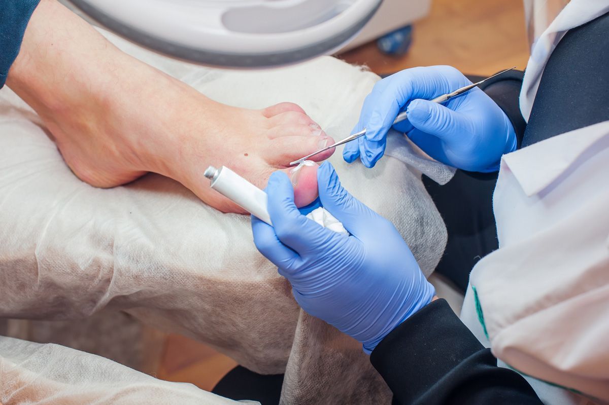 Podiatrist Treating Toenail Fungus | Warrensburg, MO | Complete Foot & Ankle Center Podiatrist Treating Toenail Fungus | Warrensburg, MO | Complete Foot & Ankle Center