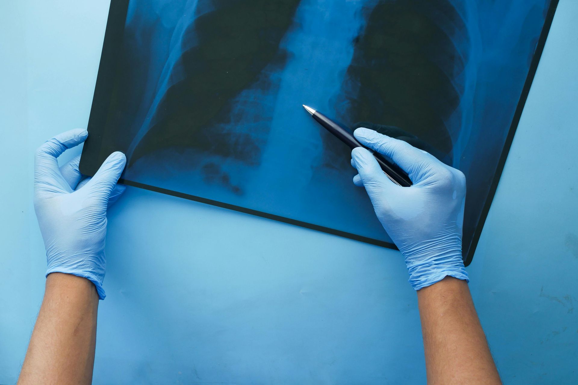 Hands in blue gloves examining an X-ray of lungs with a pen on a blue surface.