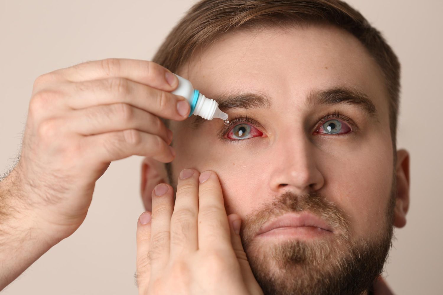 Man using eye drops to treat red, irritated eye.
