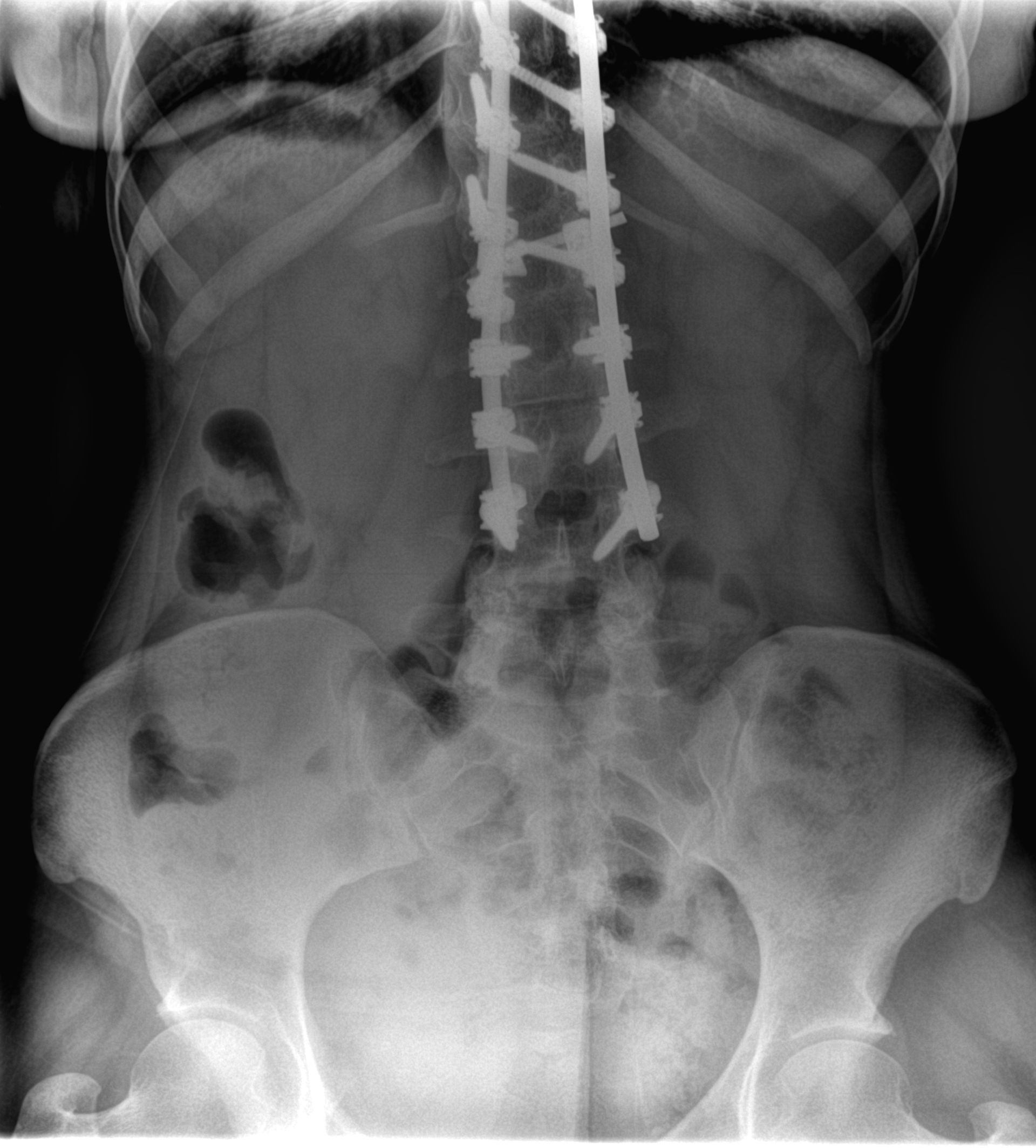 Doctor in mask and blue gloves pointing at an X-ray of a spine