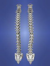 Scoliosis