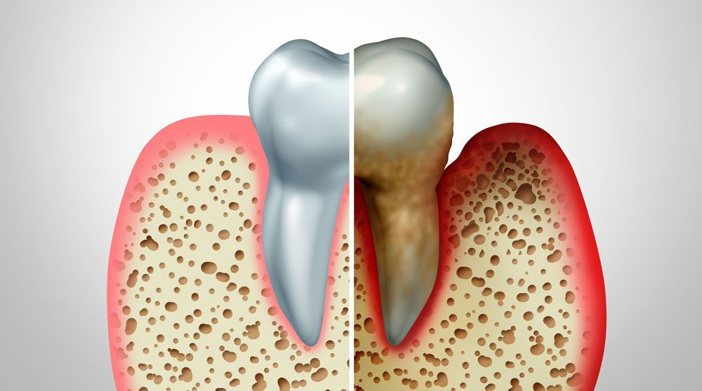 How do you know if you have gum disease?