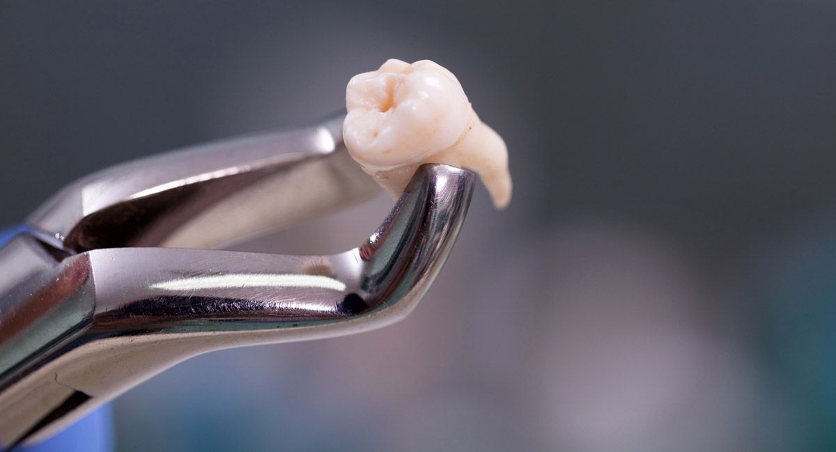 How to Prevent Tooth Loss