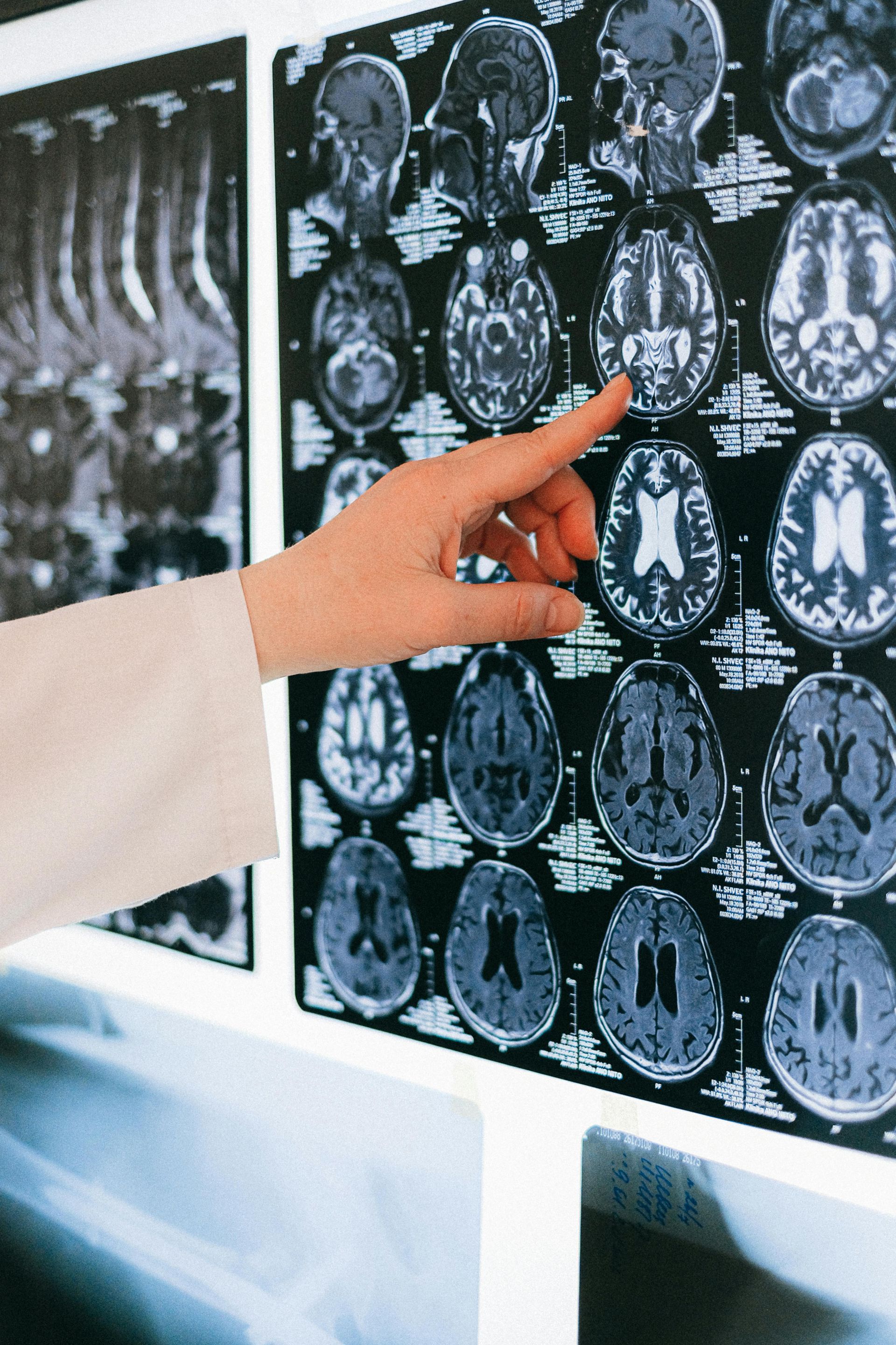 Hand pointing at brain scan images on a lightbox in a medical setting