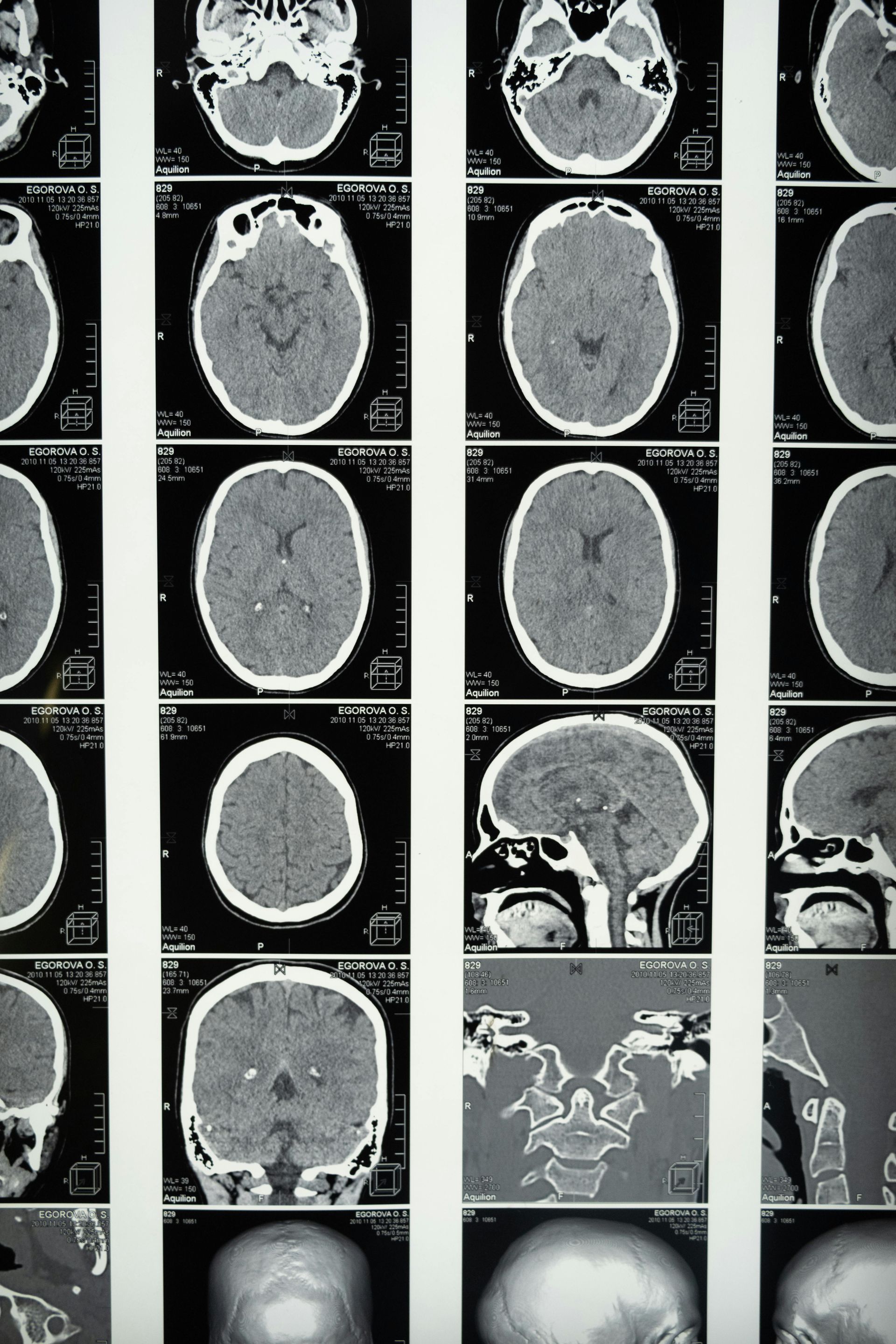 Grid of brain CT scan slices in black, white, and gray, showing multiple cross-sectional views