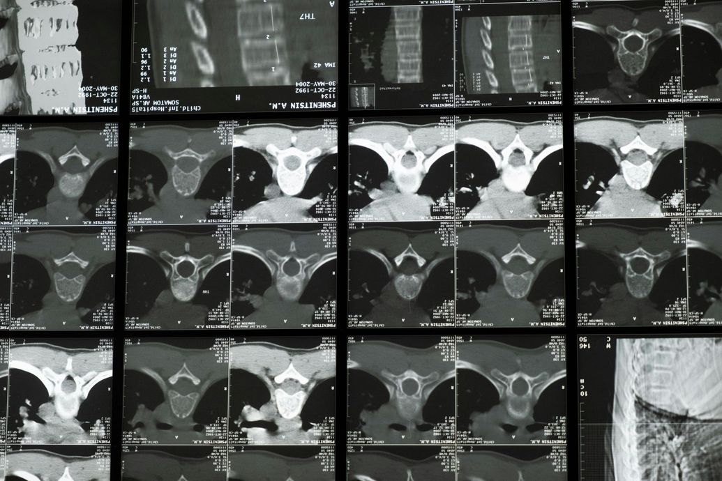 Medical CT scan montage on a monitor, showing multiple black-and-white cross-sectional body images.