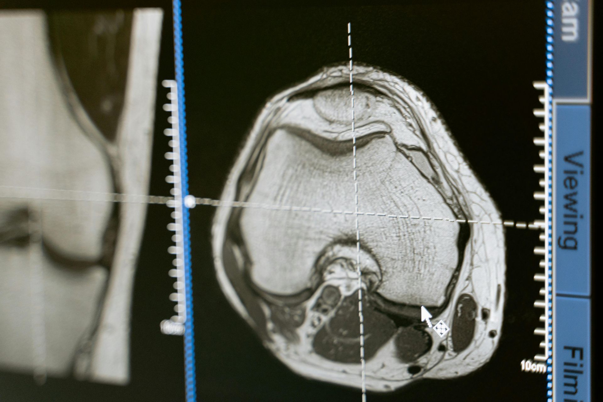 Medical scan cross-section displayed on a monitor, with measurement guides and a zoomed inset view.