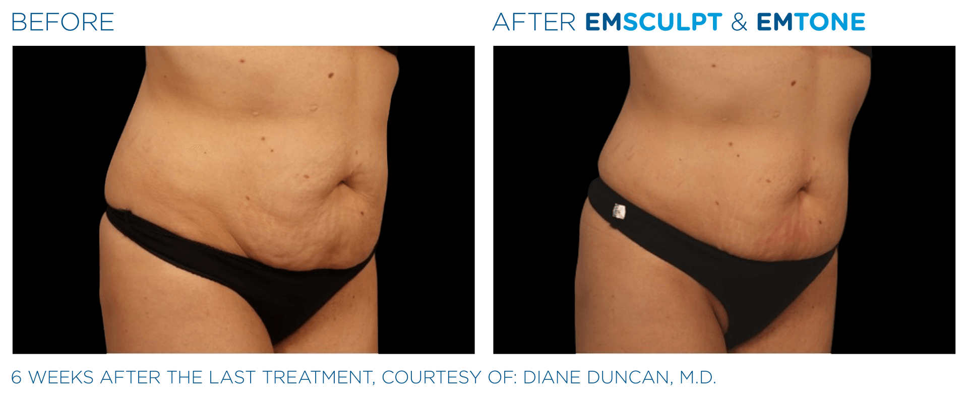 A before and after picture of a woman 's stomach